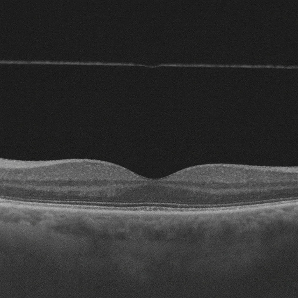 Décollement postérieur du vitré - examen fond d'œil